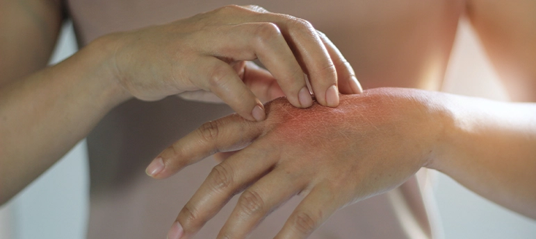 Permanent Cure from Our Psoriasis Treatment 