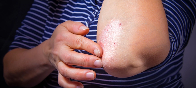 psoriasis treatment in Tigris Valley Retreat