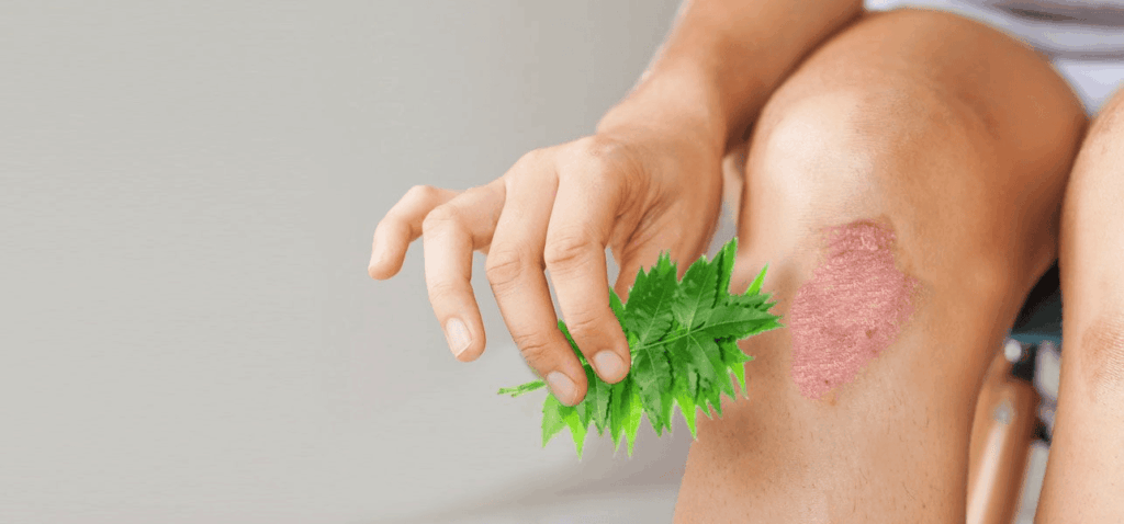 Ayurvedic psoriasis permanent treatment 