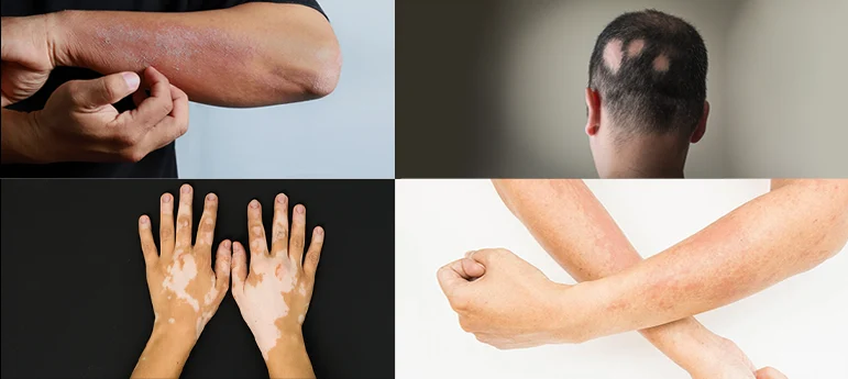 skin diseases treatment in Kerala