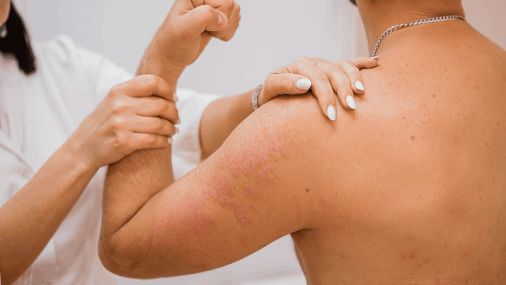 psoriasis treatment in ayurveda