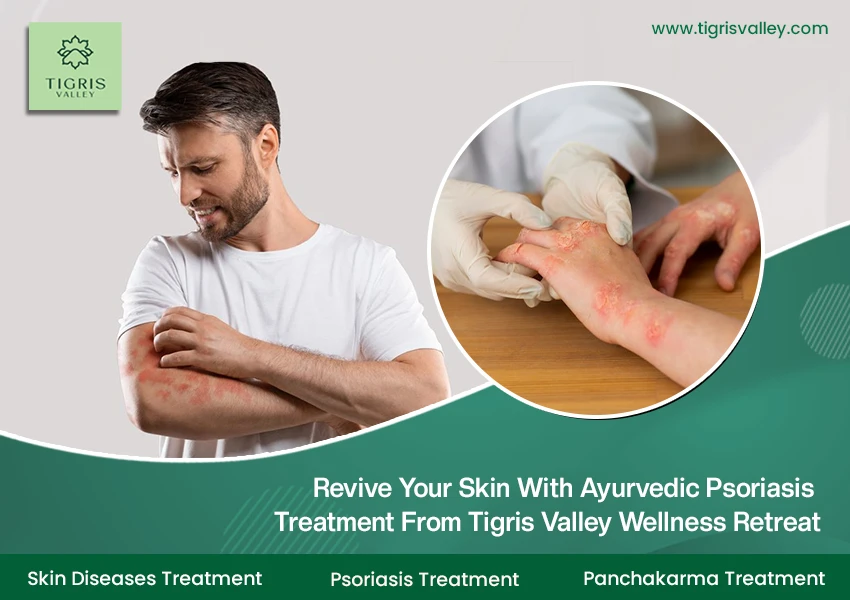 Ayurvedic Psoriasis Treatment in Kerala | Tigris Valley