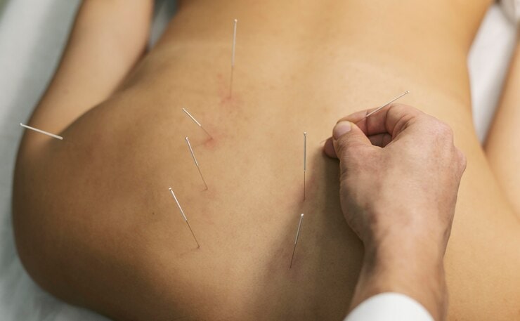acupuncture treatment